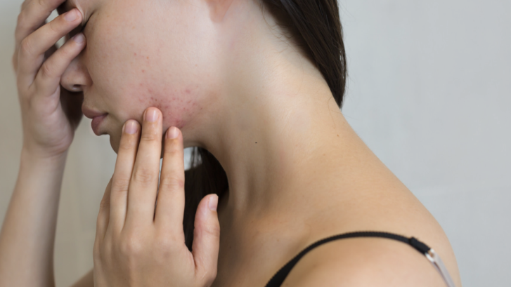 Acne Dermatology Appointments in Prince Frederick Maryland